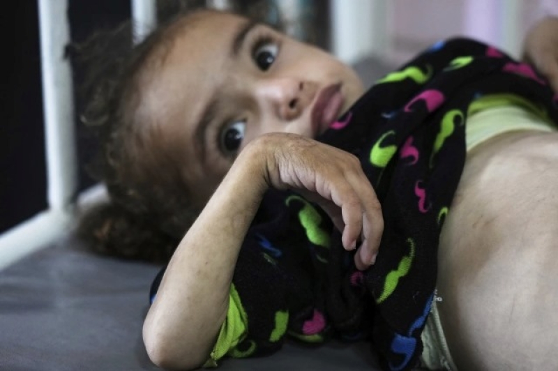 mayar-al-arja-2-who-suffers-from-malnutrition-lies-on-a-bed-in-a-clinic-in-nasser-hospital-khan-younis-gaza-wednesday-may-21-2025-7e21d8d21bb49d904adf19462ea62b7e1747974408.jpg